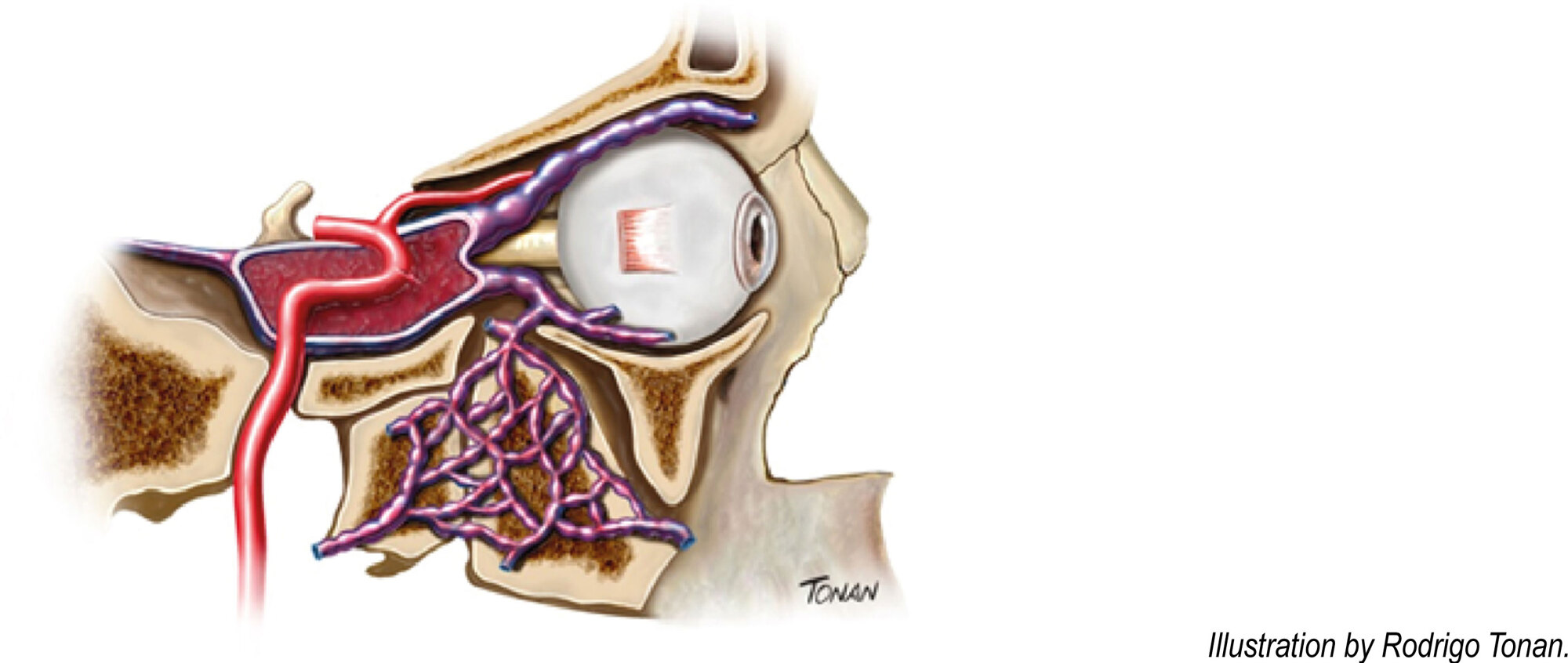 Use Of Color Doppler Of Carotids In The Diagnosis Of A Patient With 