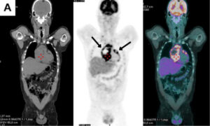 Angiossarcoma Primário Cardíaco Avaliado em PET/TC - ABC Imaging